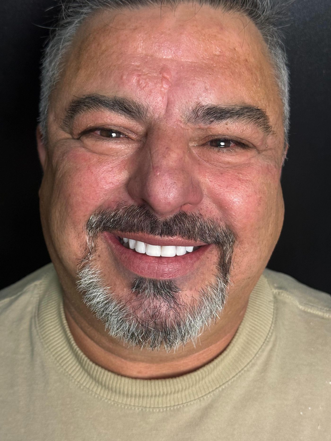 Paciente sorrindo após reabilitação com implantes na Crídente